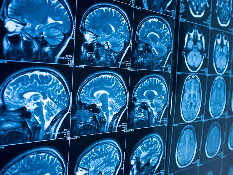 Multiple brain MRI scans displayed in blue tones.