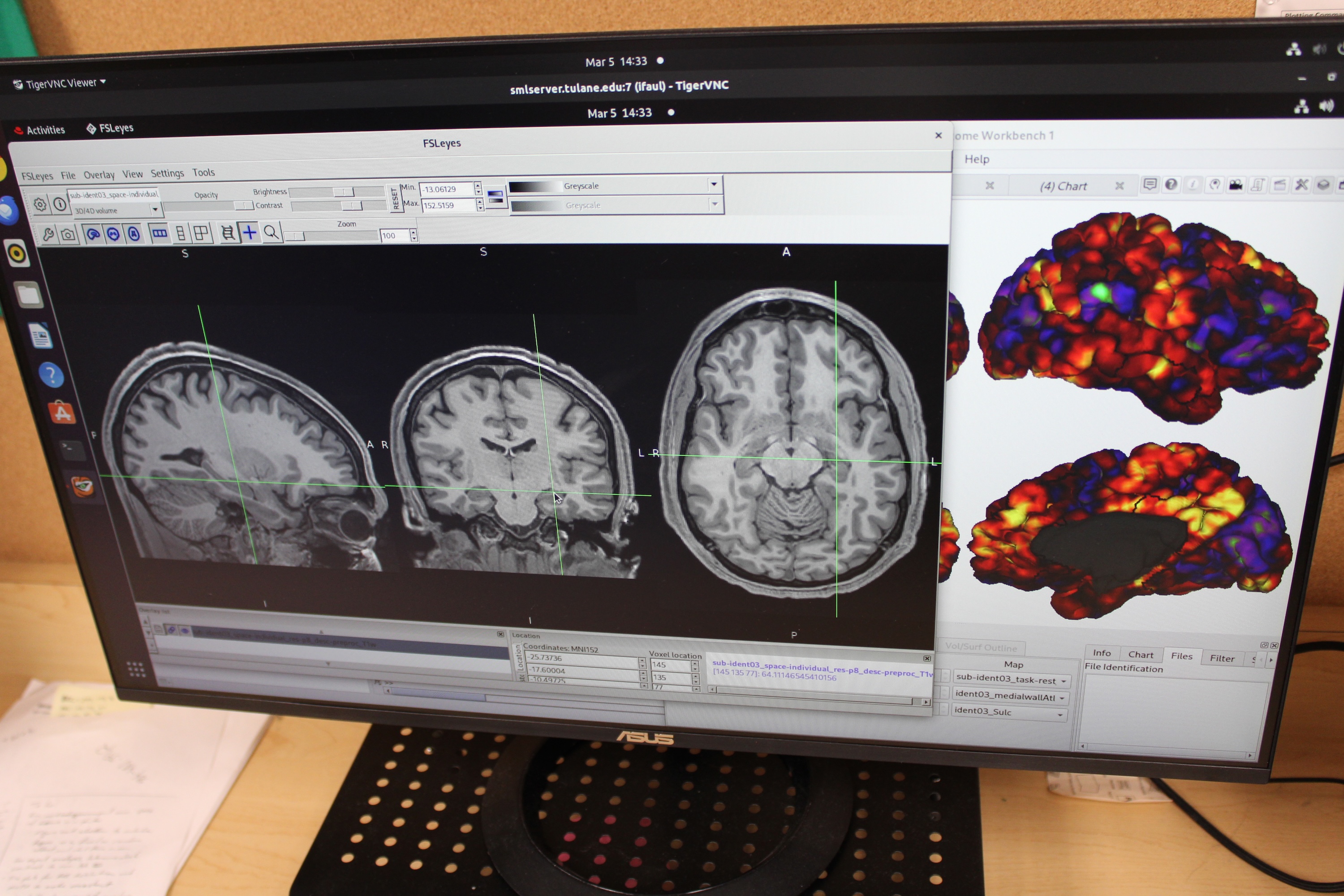 Computer screen with black and white images of brain scans