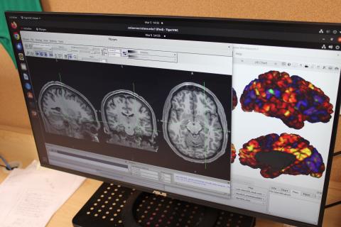 Computer monitor displaying brain scans and colorful brain activity maps.